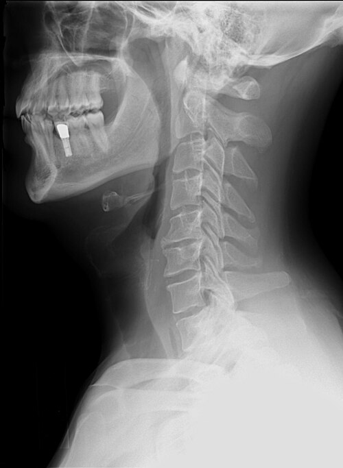 Lateral neck X-ray showing degenerative changes
