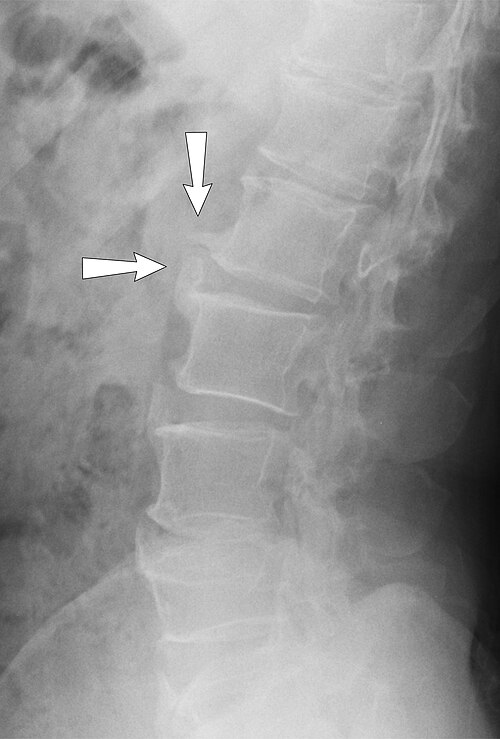 Lateral low back X-ray showing degenerative changes